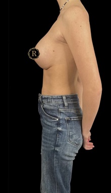 Breast Augmentation After Photo by Babis Rammos, MD, FACS; Peoria, IL - Case 47894
