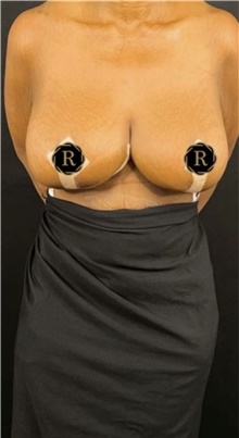 Breast Reduction After Photo by Babis Rammos, MD, FACS; Peoria, IL - Case 47898