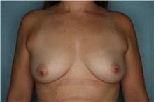 Breast Augmentation Before Photo by Kiranjeet Gill, MD; Naples, FL - Case 48626