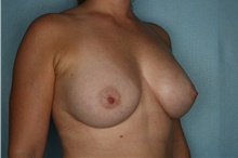 Breast Augmentation After Photo by Kiranjeet Gill, MD; Naples, FL - Case 48626