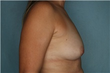 Breast Augmentation Before Photo by Kiranjeet Gill, MD; Naples, FL - Case 48626