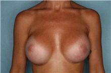Breast Augmentation After Photo by Kiranjeet Gill, MD; Naples, FL - Case 48627