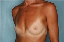 Breast Augmentation Before Photo by Kiranjeet Gill, MD; Naples, FL - Case 48627