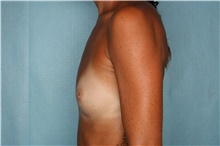 Breast Augmentation Before Photo by Kiranjeet Gill, MD; Naples, FL - Case 48627