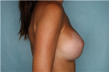 Breast Augmentation After Photo by Kiranjeet Gill, MD; Naples, FL - Case 48627