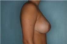 Breast Reduction After Photo by Kiranjeet Gill, MD; Naples, FL - Case 48628