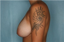 Breast Reduction Before Photo by Kiranjeet Gill, MD; Naples, FL - Case 48628