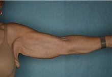 Arm Lift Before Photo by Kiranjeet Gill, MD; Naples, FL - Case 48630
