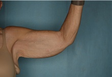 Arm Lift Before Photo by Kiranjeet Gill, MD; Naples, FL - Case 48630