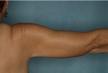 Arm Lift After Photo by Kiranjeet Gill, MD; Naples, FL - Case 48630