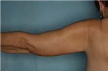 Arm Lift After Photo by Kiranjeet Gill, MD; Naples, FL - Case 48630