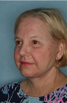 Facelift After Photo by Kiranjeet Gill, MD; Naples, FL - Case 48631
