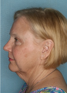 Facelift Before Photo by Kiranjeet Gill, MD; Naples, FL - Case 48631