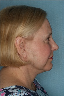 Facelift After Photo by Kiranjeet Gill, MD; Naples, FL - Case 48631