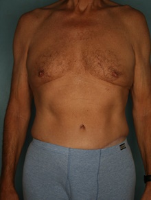 Tummy Tuck After Photo by Kiranjeet Gill, MD; Naples, FL - Case 48632