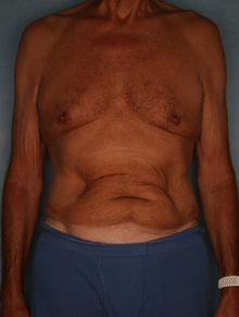 Tummy Tuck Before Photo by Kiranjeet Gill, MD; Naples, FL - Case 48632