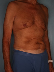 Tummy Tuck Before Photo by Kiranjeet Gill, MD; Naples, FL - Case 48632