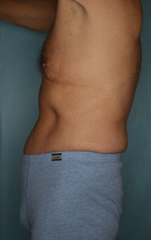 Tummy Tuck After Photo by Kiranjeet Gill, MD; Naples, FL - Case 48632