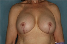Breast Implant Revision After Photo by Kiranjeet Gill, MD; Naples, FL - Case 48633