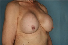 Breast Implant Revision Before Photo by Kiranjeet Gill, MD; Naples, FL - Case 48633