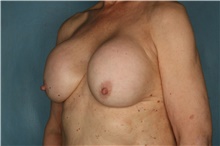Breast Implant Revision Before Photo by Kiranjeet Gill, MD; Naples, FL - Case 48633