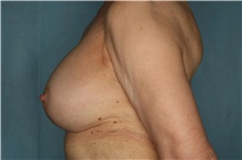 Breast Implant Revision After Photo by Kiranjeet Gill, MD; Naples, FL - Case 48633