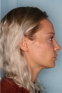 Dermal Fillers Before Photo by Kiranjeet Gill, MD; Naples, FL - Case 48635