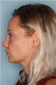 Dermal Fillers Before Photo by Kiranjeet Gill, MD; Naples, FL - Case 48635