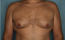 Male Breast Reduction Before Photo by Kiranjeet Gill, MD; Naples, FL - Case 48638