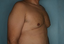 Male Breast Reduction After Photo by Kiranjeet Gill, MD; Naples, FL - Case 48638