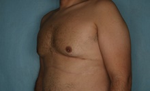 Male Breast Reduction After Photo by Kiranjeet Gill, MD; Naples, FL - Case 48638