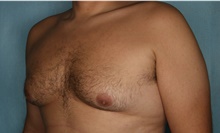 Male Breast Reduction Before Photo by Kiranjeet Gill, MD; Naples, FL - Case 48638