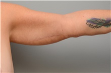 Arm Lift After Photo by Carlos Rivera-Serrano, MD; Bay Harbour Islands, FL - Case 43628