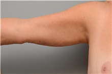 Arm Lift After Photo by Carlos Rivera-Serrano, MD; Bay Harbour Islands, FL - Case 43628