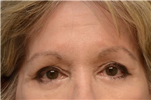 Botulinum Toxin After Photo by Carlos Rivera-Serrano, MD; Bay Harbour Islands, FL - Case 43633