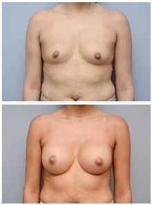 Breast Augmentation Before Photo by Carlos Rivera-Serrano, MD; Bay Harbour Islands, FL - Case 43634