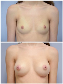 Breast Augmentation Before Photo by Carlos Rivera-Serrano, MD; Bay Harbour Islands, FL - Case 43635