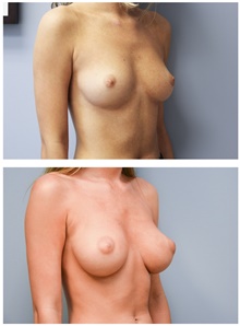 Breast Augmentation After Photo by Carlos Rivera-Serrano, MD; Bay Harbour Islands, FL - Case 43636