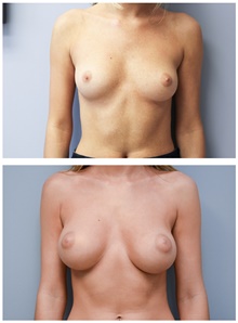 Breast Augmentation Before Photo by Carlos Rivera-Serrano, MD; Bay Harbour Islands, FL - Case 43636