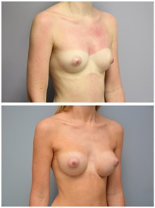 Breast Augmentation After Photo by Carlos Rivera-Serrano, MD; Bay Harbour Islands, FL - Case 43637