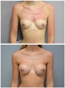 Breast Augmentation Before Photo by Carlos Rivera-Serrano, MD; Bay Harbour Islands, FL - Case 43637