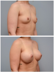 Breast Augmentation After Photo by Carlos Rivera-Serrano, MD; Bay Harbour Islands, FL - Case 43638