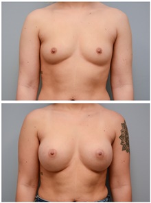 Breast Augmentation Before Photo by Carlos Rivera-Serrano, MD; Bay Harbour Islands, FL - Case 43638