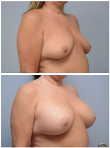 Breast Augmentation After Photo by Carlos Rivera-Serrano, MD; Bay Harbour Islands, FL - Case 43639