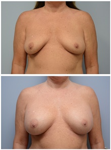 Breast Augmentation Before Photo by Carlos Rivera-Serrano, MD; Bay Harbour Islands, FL - Case 43639