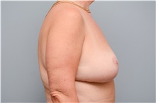 Breast Lift After Photo by Carlos Rivera-Serrano, MD; Bay Harbour Islands, FL - Case 43640