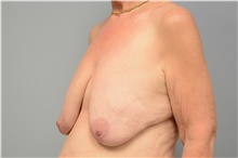 Breast Lift Before Photo by Carlos Rivera-Serrano, MD; Bay Harbour Islands, FL - Case 43640