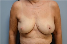 Breast Lift After Photo by Carlos Rivera-Serrano, MD; Bay Harbour Islands, FL - Case 43642