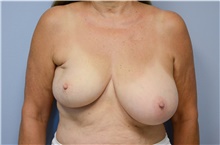 Breast Lift Before Photo by Carlos Rivera-Serrano, MD; Bay Harbour Islands, FL - Case 43642