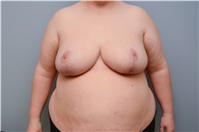 Breast Reduction After Photo by Carlos Rivera-Serrano, MD; Bay Harbour Islands, FL - Case 43644